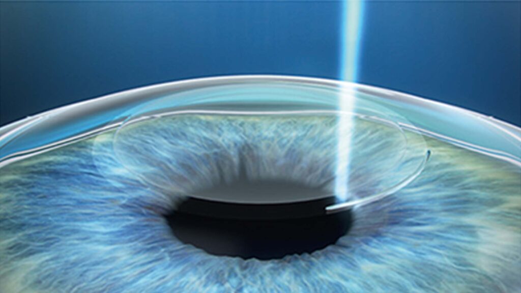 lasik eye